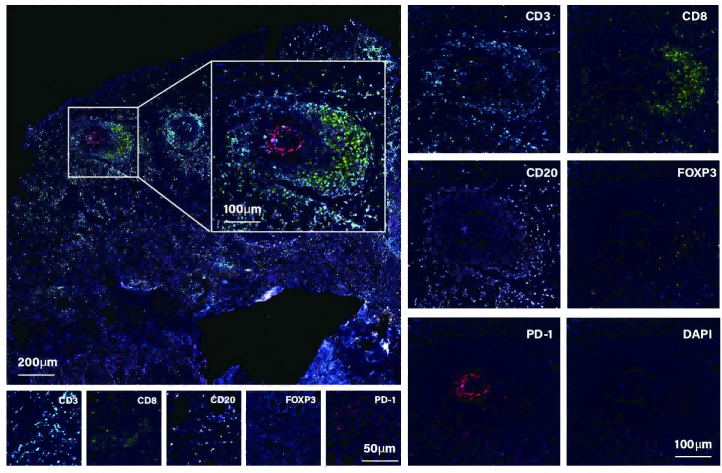 双指标联动| PD-1+Treg/PD-1+CD8 比值与 三级淋巴结构TLS 在晚期胃癌术前治疗中的预后及响应关联