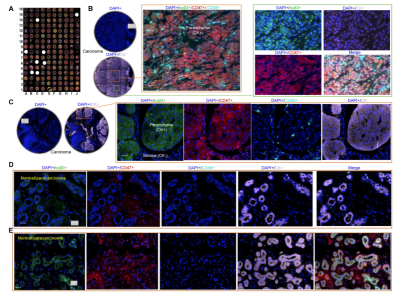 119 例临床样本验证 | Tissue Cytometry 技术锁定乳腺癌 CD47/αvβ3 共稳定关键，推动癌症免疫治疗突破